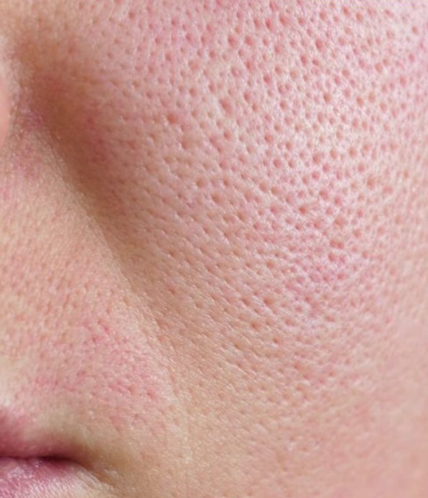 12 Natural Tips for Minimizing Open Pores at Home